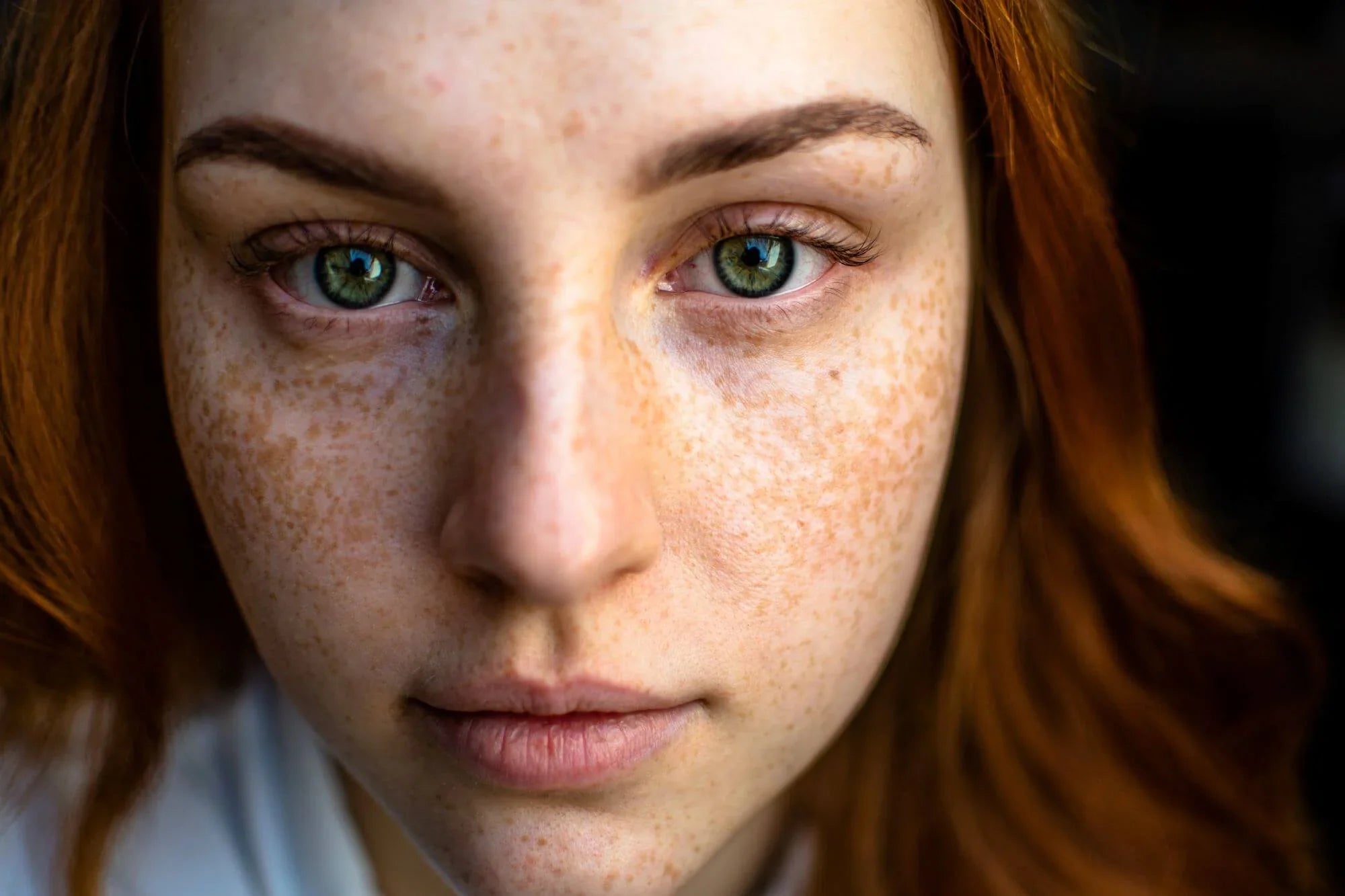 What Causes Acne and How to Treat it