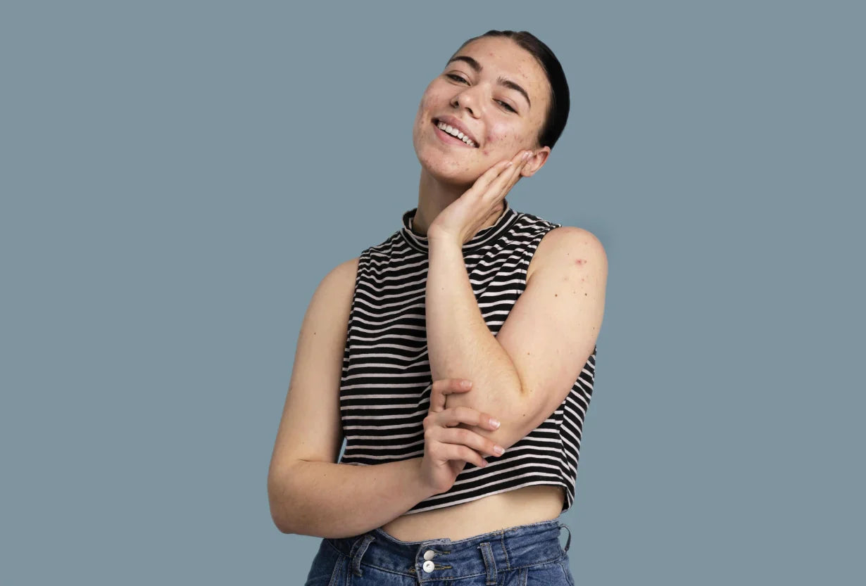 How Can Face Creams Help with Acne-Prone Skin?