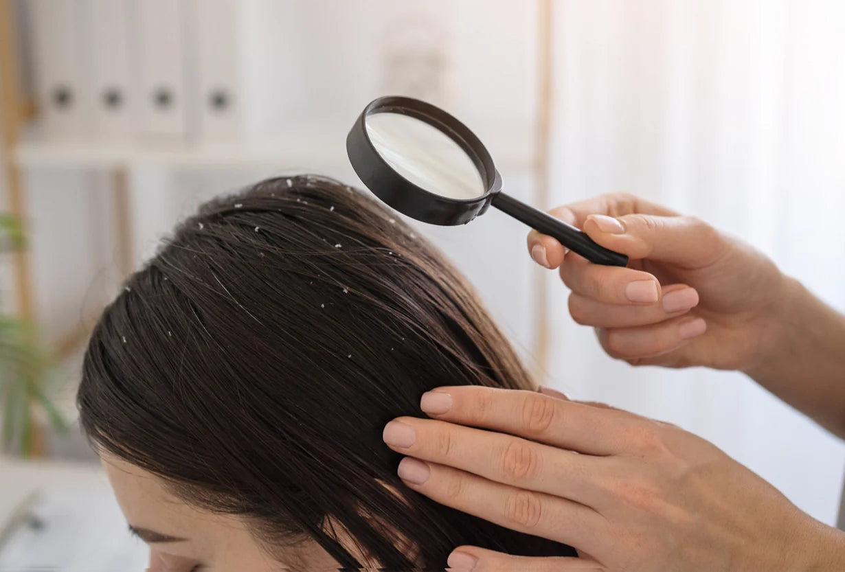 What's the Best Solution for Dandruff on a Greasy Scalp?